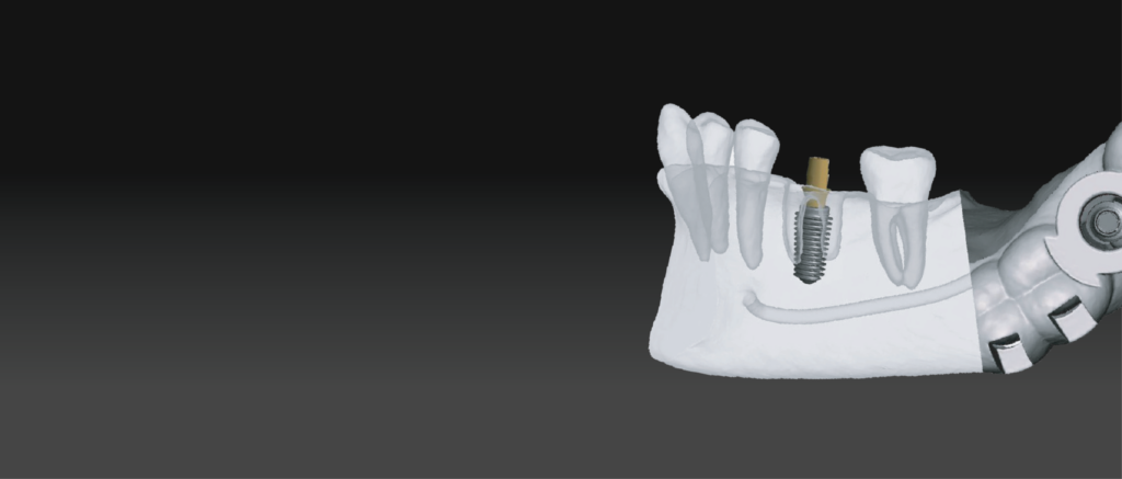 The Perfect Match: carga inmediata guiada