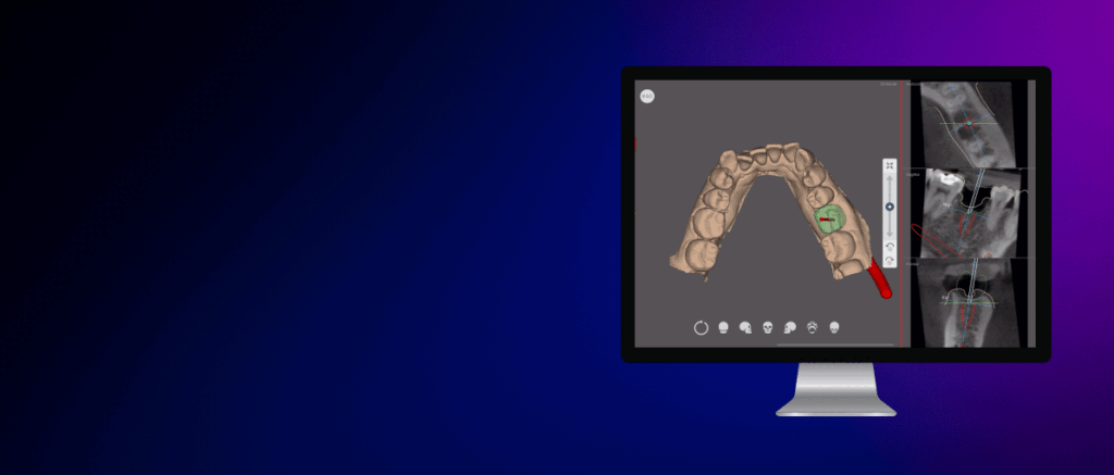 Cirugía guiada con R2Gate