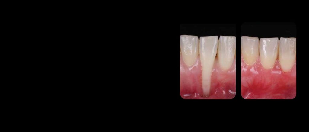 Cirugía mucogingival avanzada